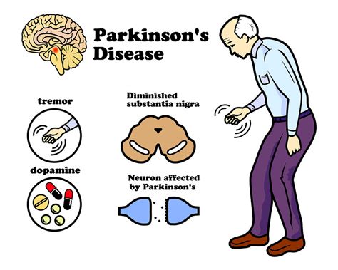 Parkinsons disease hereditory  slowing of thoughts